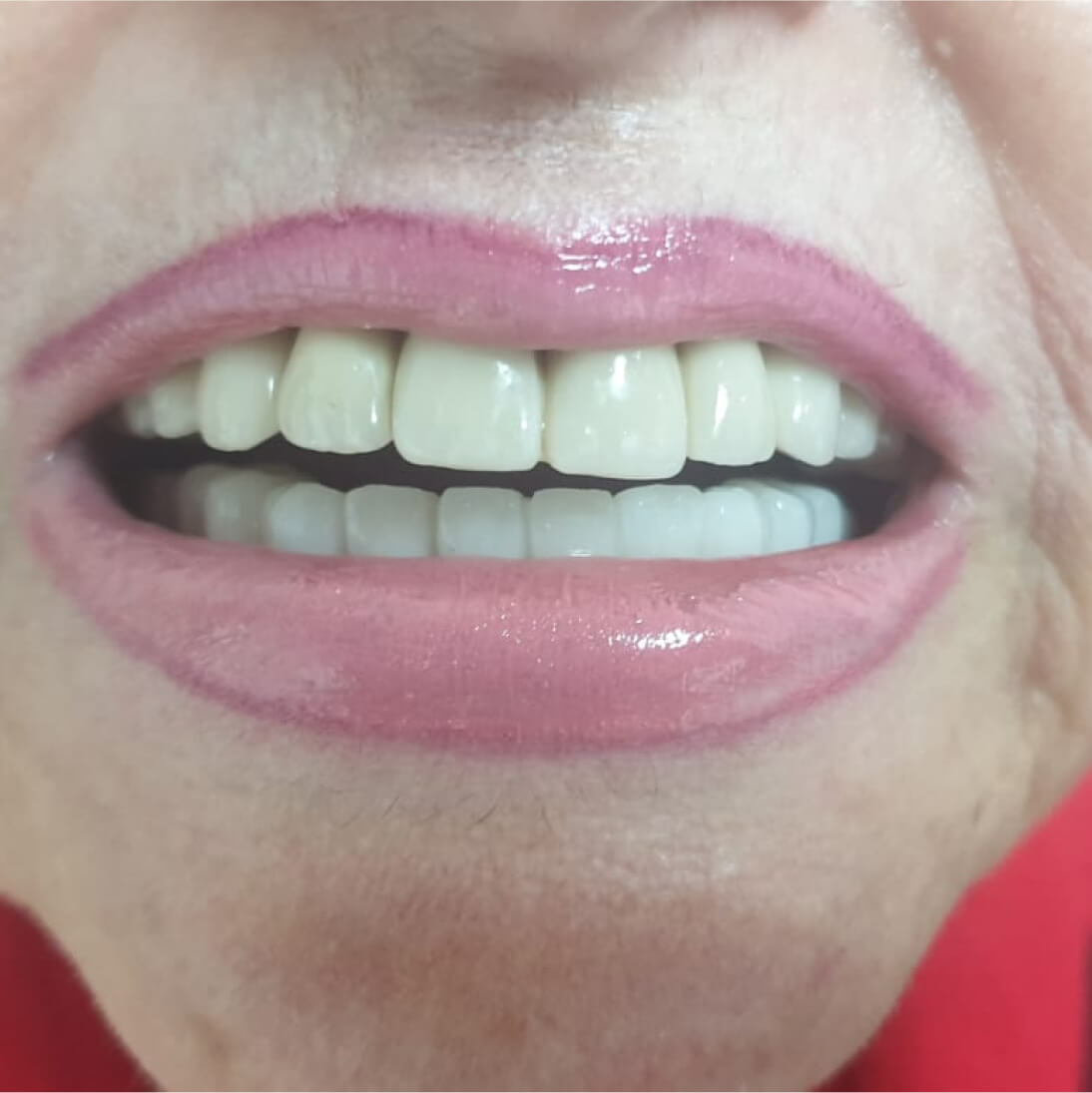Зубы после имплантации