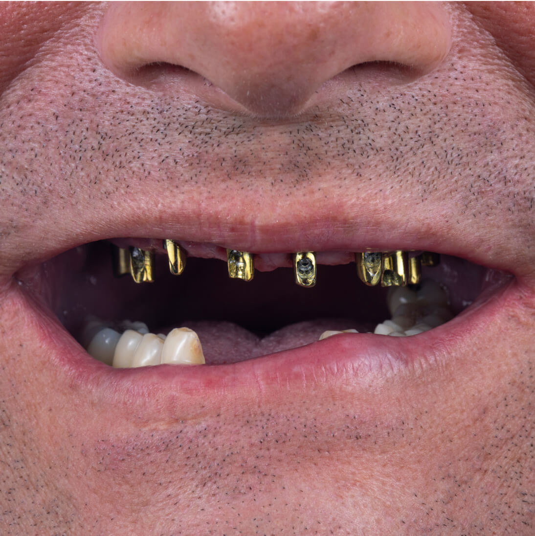 Зубы до имплантации