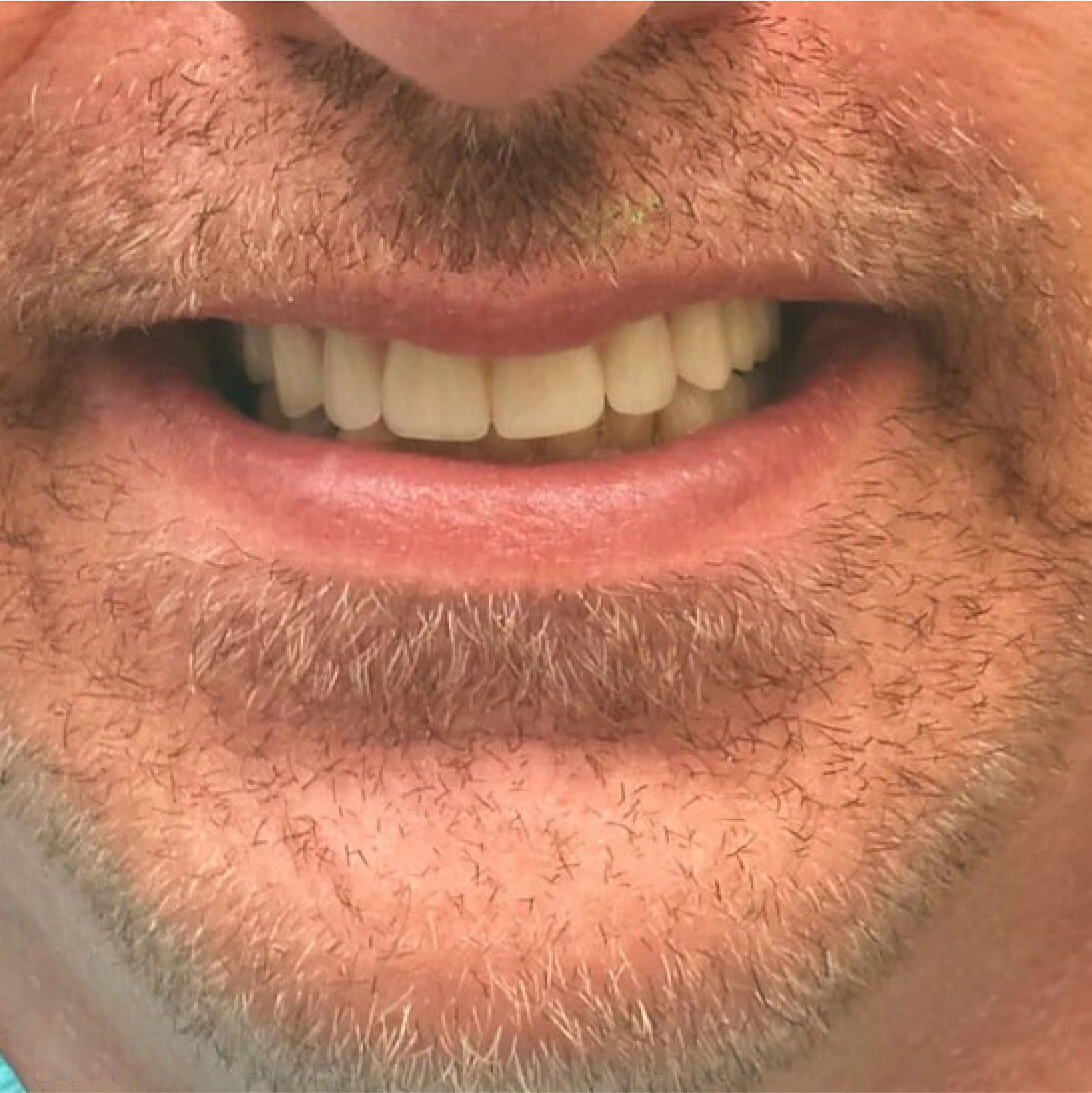 Зубы после имплантации